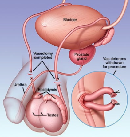ont i prostatan ont i prostatan