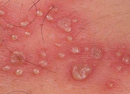 munherpes i underlivet munherpes i underlivet