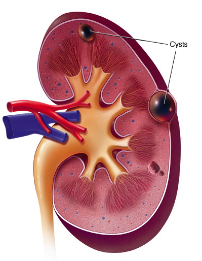 njurcysta,njurcysta internetmedicin,njurcysta klassificering,njurcysta utredning,njurcysta smärta,njurcysta symtom,njurcysta bosniak 3,njurcysta storlek,njurcysta uppföljning,njurcysta internetmedicin,njurcysta klassificering,njurcysta utredning,njurcysta smärta,njurcysta symtom,njurcysta bosniak 3,njurcysta behandling,njurcysta storlek,njurcysta uppföljning