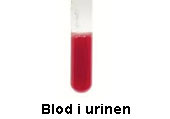 undersökningar vid blod i urinen,urinvägsinfektion,urinvägsinflammation,ont i urinblåsan,urinblåsa,cancer symptom,ont i urinröret,urinblåsecancer,ont i njurarna,njurbäckeninflammation utan feber,cancer i urinblåsan,urinvägarna,urinblåsecancer dödlighet,njursjukdomar,symtom cancer,ont i njuren,njurbäckeninflammation symtom,protein i urin,ont i sidan,njurbäckeninflammation,hematuri,ont i prostatan,täta trängningar,blåscancer,njurproblem,1177 urinvägsinfektion,protein i urinen,brun urin,njurar ont,njurbäckeninflammation barn,urinary cancer,gul urin,orange urine,grönt kiss,gult kiss,grumligt kiss,mikroskopisk hematuri,hematuria,brunt kiss,urininfektion symptom,blodcancer,urin,blood for blood,blood in urine,blod i urinen,