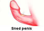 peyronies syndrom,xiapex kostnad,snoppen har blivit mindre,bota peyronies,xiapex pris,peyronies sjukdom icd 10,nesbits operation,peyronies stockholm,peyronies,peyronie's disease,peyronie's disease treatment,peyronie's treatment,peyronie's disease images,peyronie's plaque,peyronie's syndrome,peyronie's disease photos,peyronie's surgery,peyronies device