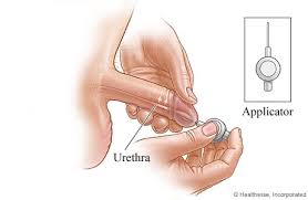 Bondil är ett sterilt uretralstift i engångsapplikator för tillförsel av alprostadil till mannens uretra.