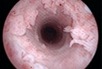 Uretra kondylom,kondylom,klamydia,syfilis,könsvårtor,könssjukdomar,vårta,plana kondylom,hpv män,gonorre symptom,hpv behandling,wartec,behandling klamydia,klamydia symptom,condyline,hpv virus män,gonorre symptom bilder,hpv symtom,kondylom test,kondylome,podofyllotoxin,kondylomy