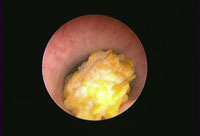 uretärsten behandling,uretärsten symtom,uretärsten operation,uretärsten icd,uretärsten engelska,uretärsten orsak,uretärsten ultraljud,uretärsten smärta,uretärsten komplikationer