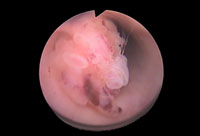 cancer i urinröret,cancer i urinröret män,cancer i urinröret kvinna,cancer i urinröret prognos,cancer i urinröret symtom,cancer i urinröret kvinna,inflammation i urinröret symtom,urinblåsecancer bilder,urinblåsecancer livslängd,urinblåsecancer berättelser,aggressiv urinblåsecancer,blod i urinen hos kvinnor,godartad blåstumör