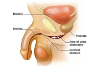 bota urinrörsförträngning,vidga urinröret själv man,uretrastriktur operation,svårt att kissa kvinna,urinrör man,urinrör kvinnor,luftbubblor i urinröret,urinvägsinfektion,urinrörsförträngning kvinna,urinrörsförträngning behandling,urinrörsförträngning efter operation,bota urinrörsförträngning,operera urinrörsförträngning